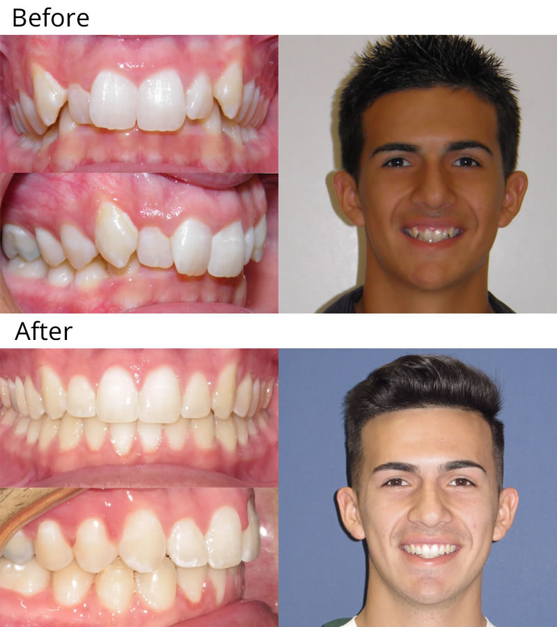 Dentist Temple TX  What are Invisalign clear braces?