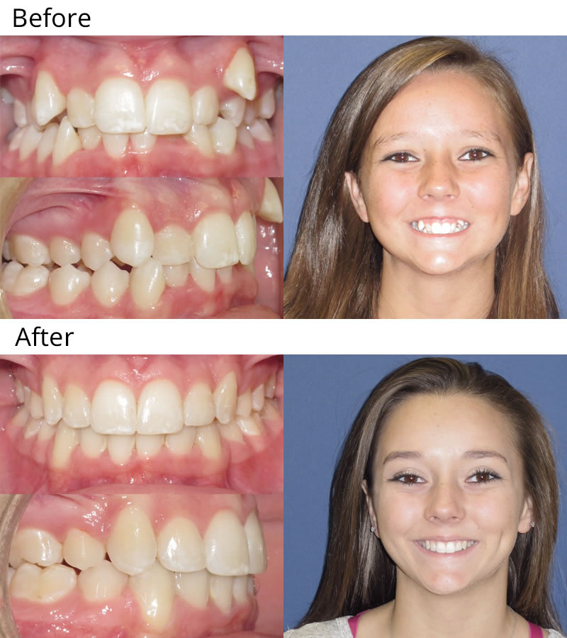 braces before and after gap