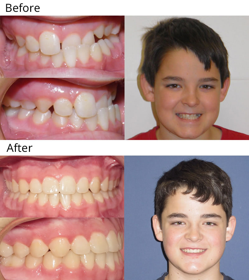 crossbite braces before after